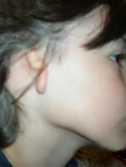 Microtia de grado III antes de la cirugía: paciente 3 antes de la reconstrucción auricular realizada por el Dr. Arturo Bonilla