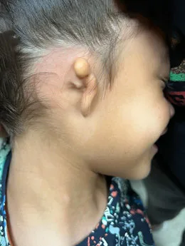 Microtia de grado III antes de la cirugía: paciente 35 antes de la reconstrucción auricular realizada por el Dr. Arturo Bonilla