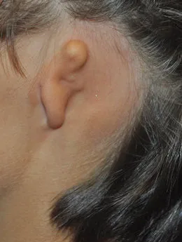 Microtia de grado III antes de la cirugía: paciente 59 antes de la reconstrucción auricular realizada por el Dr. Arturo Bonilla