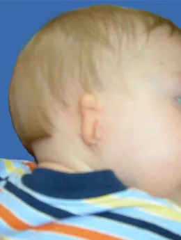 Microtia de grado III antes de la cirugía: paciente 8 antes de la reconstrucción auricular realizada por el Dr. Arturo Bonilla