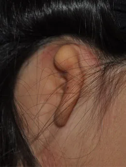 Microtia de grado III antes de la cirugía: paciente 23 antes de la reconstrucción auricular realizada por el Dr. Arturo Bonilla