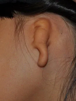 Microtia de grado III antes de la cirugía: paciente 57 antes de la reconstrucción auricular realizada por el Dr. Arturo Bonilla