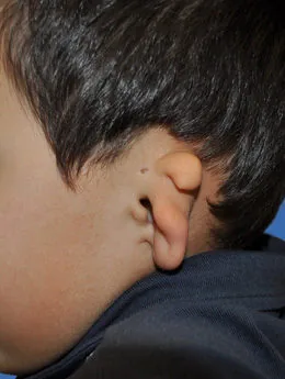 Microtia de grado III antes de la cirugía: paciente 11 antes de la reconstrucción auricular realizada por el Dr. Arturo Bonilla