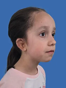Resultado postoperatorio: paciente 22 después de la reconstrucción auricular con cartílago costal natural realizada por el Dr. Arturo Bonilla