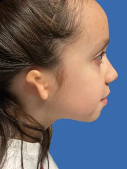 Microtia de grado III antes de la cirugía: paciente 22 antes de la reconstrucción auricular realizada por el Dr. Arturo Bonilla
