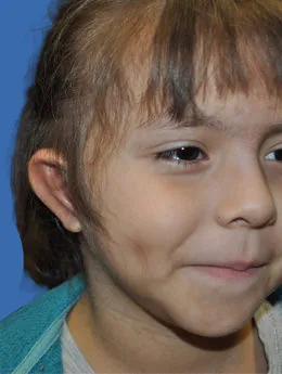 Resultado postoperatorio: paciente 54 después de la reconstrucción auricular con cartílago costal natural realizada por el Dr. Arturo Bonilla