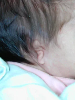 Microtia de grado III antes de la cirugía: paciente 54 antes de la reconstrucción auricular realizada por el Dr. Arturo Bonilla