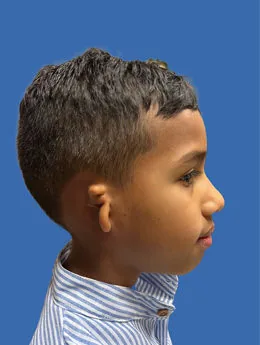Microtia de grado III antes de la cirugía: paciente 64 antes de la reconstrucción auricular realizada por el Dr. Arturo Bonilla