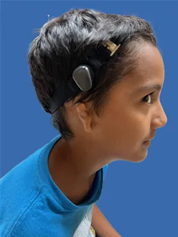 Microtia de grado III antes de la cirugía: paciente 38 antes de la reconstrucción auricular realizada por el Dr. Arturo Bonilla