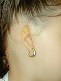 Microtia de grado III antes de la cirugía: paciente 37 antes de la reconstrucción auricular realizada por el Dr. Arturo Bonilla