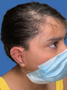 Resultado postoperatorio: paciente 56 después de la reconstrucción auricular con cartílago costal natural realizada por el Dr. Arturo Bonilla