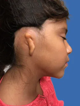 Microtia de grado III antes de la cirugía: paciente 56 antes de la reconstrucción auricular realizada por el Dr. Arturo Bonilla