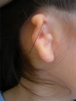 Microtia de grado III antes de la cirugía: paciente 55 antes de la reconstrucción auricular realizada por el Dr. Arturo Bonilla