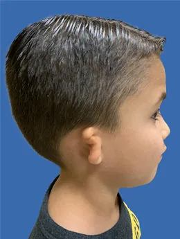 Microtia de grado III antes de la cirugía: paciente 18 antes de la reconstrucción auricular realizada por el Dr. Arturo Bonilla