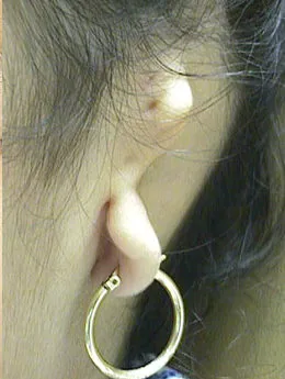 Microtia de grado III antes de la cirugía: paciente 10 antes de la reconstrucción auricular realizada por el Dr. Arturo Bonilla