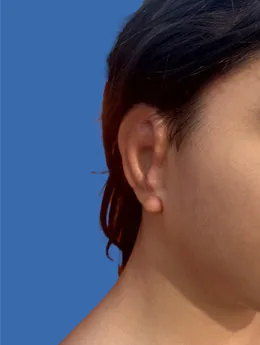 Resultado postoperatorio: paciente 50 después de la reconstrucción auricular con cartílago costal natural realizada por el Dr. Arturo Bonilla