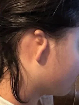 Microtia de grado III antes de la cirugía: paciente 50 antes de la reconstrucción auricular realizada por el Dr. Arturo Bonilla