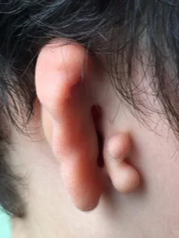 Microtia de grado III antes de la cirugía: paciente 67 antes de la reconstrucción auricular realizada por el Dr. Arturo Bonilla