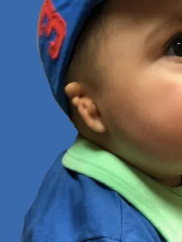 Microtia de grado III antes de la cirugía: paciente 26 antes de la reconstrucción auricular realizada por el Dr. Arturo Bonilla