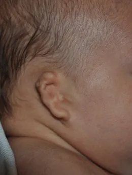 Microtia de grado III antes de la cirugía: paciente 48 antes de la reconstrucción auricular realizada por el Dr. Arturo Bonilla