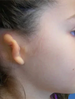 Microtia de grado III antes de la cirugía: paciente 7 antes de la reconstrucción auricular realizada por el Dr. Arturo Bonilla