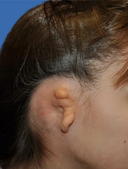 Microtia de grado III antes de la cirugía: paciente 14 antes de la reconstrucción auricular realizada por el Dr. Arturo Bonilla