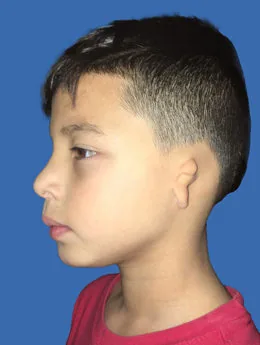 Microtia de grado III antes de la cirugía: paciente 34 antes de la reconstrucción auricular realizada por el Dr. Arturo Bonilla