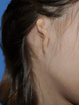 Microtia de grado III antes de la cirugía: paciente 58 antes de la reconstrucción auricular realizada por el Dr. Arturo Bonilla