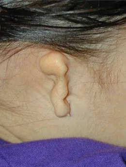 Microtia de grado III antes de la cirugía: paciente 45 antes de la reconstrucción auricular realizada por el Dr. Arturo Bonilla