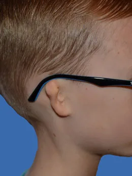 Microtia de grado III antes de la cirugía: paciente 21 antes de la reconstrucción auricular realizada por el Dr. Arturo Bonilla