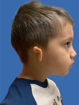 Microtia de grado III antes de la cirugía: paciente 61 antes de la reconstrucción auricular realizada por el Dr. Arturo Bonilla