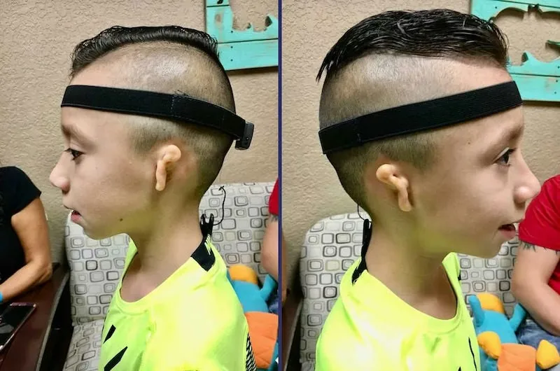 Bilateral microtia patient showing both ears before reconstruction surgery — Grade III microtia affecting both sides