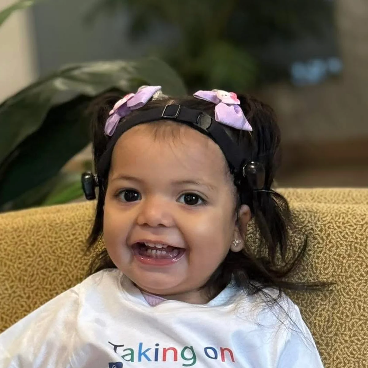 Child with Grade 3 microtia and aural atresia wearing a softband hearing device