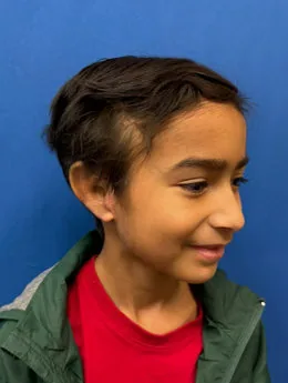 After microtia reconstruction — postoperative result
