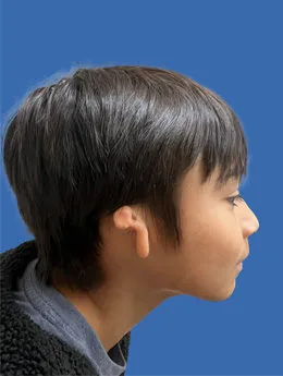 Before microtia reconstruction — Grade 3 microtia