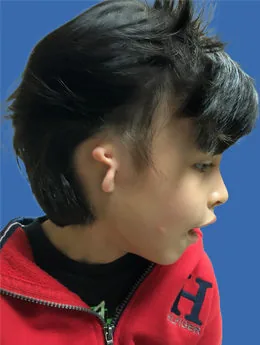 Microtia de grado III antes de la cirugía: paciente 16 antes de la reconstrucción auricular realizada por el Dr. Arturo Bonilla