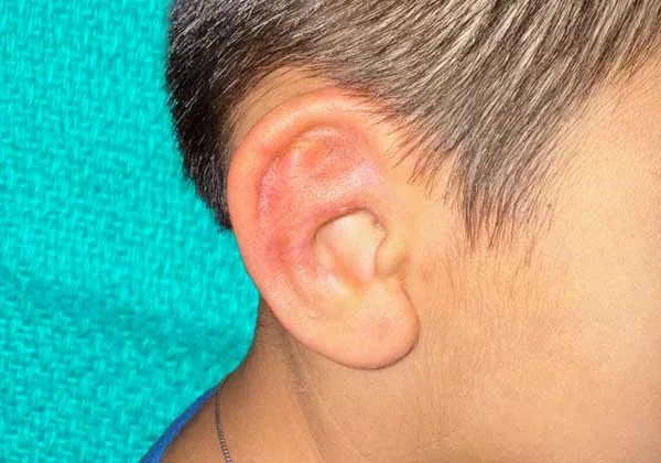A close-up of a child's ear shows the healed result after rib cartilage microtia reconstruction, with a naturally shaped ear still showing some redness consistent with early healing. The reconstructed ear displays the detailed cartilage framework achievable through microtia surgery using the child's own rib cartilage.