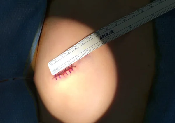 A close-up surgical photo shows a small sutured chest incision measured against a Medline ruler, demonstrating the minimal scarring left after rib cartilage is harvested for microtia reconstruction.