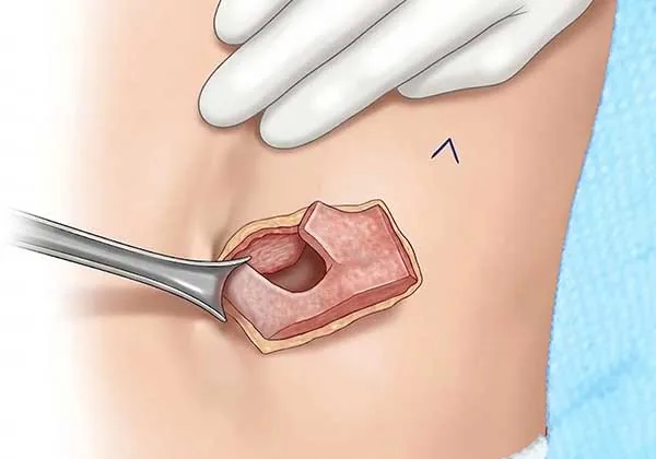 A medical illustration shows a surgical instrument lifting a block of rib cartilage through a small chest incision during microtia reconstruction. Harvesting rib cartilage from the chest is the first step in building a natural ear framework for microtia surgery.