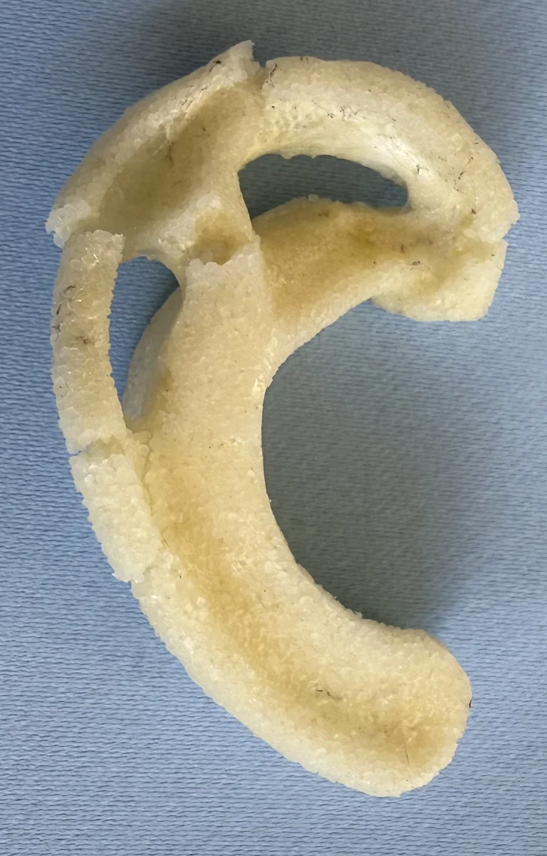 A fractured synthetic porous polyethylene ear implant, broken in multiple places, removed during microtia revision surgery — an example of the fracture risk inherent to rigid implant frameworks