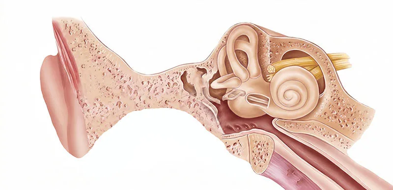 Medical diagram showing aural atresia, fused middle ear ossicles, and normal inner ear anatomy in microtia patients
