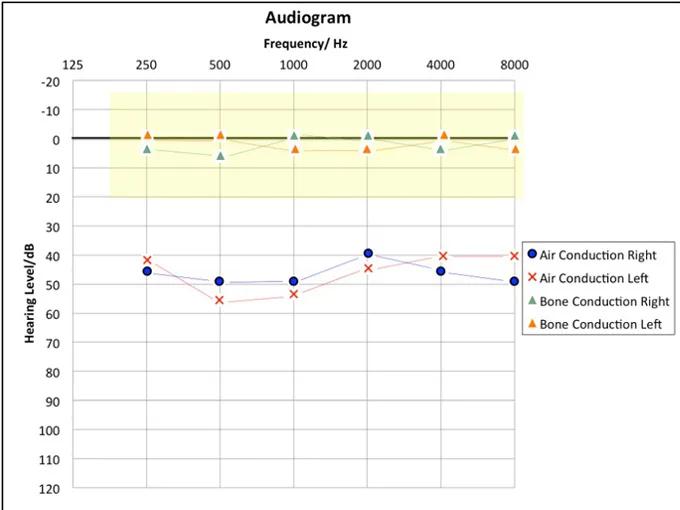 Audiogram showing conductive hearing loss pattern in a microtia patient — bone conduction thresholds near normal while air conduction shows 40-50 dB loss, confirming intact inner ear function