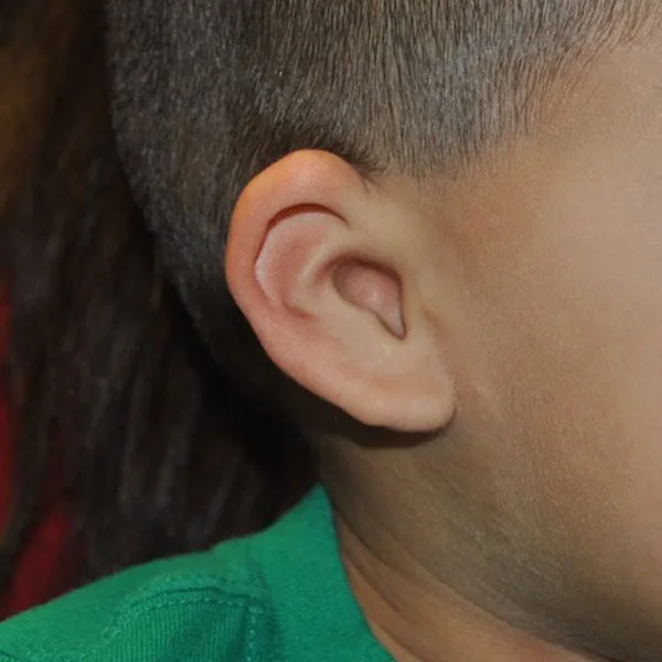 Grade I microtia — mild form showing a smaller but recognizable ear with all major structures present
