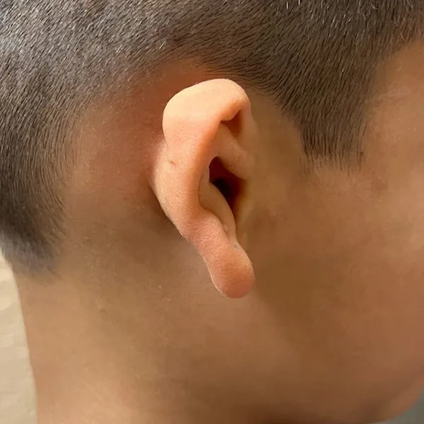 Grade II microtia — moderate form showing partial ear development with some recognizable structures present