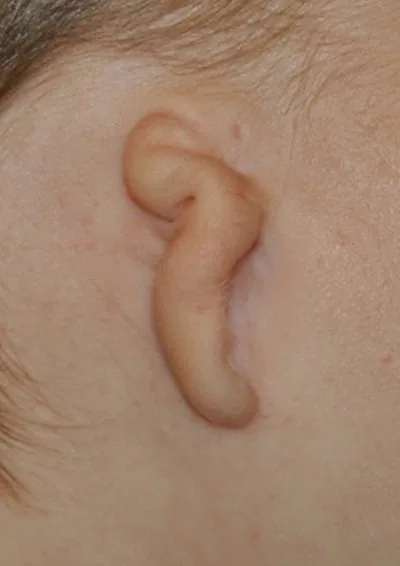 A close-up of a child's ear showing Grade 3 microtia, where only a small hook-shaped remnant of cartilage and tissue is present with no recognizable ear structure. This is the most common severity level treated by microtia surgery reconstruction.
