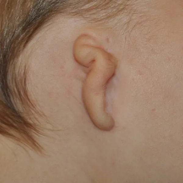 Grade III microtia — severe classic form showing the typical peanut-shaped cartilage remnant, the most common type