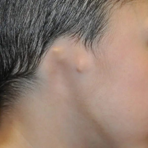 Grade IV microtia — anotia, the most severe form showing complete absence of the external ear