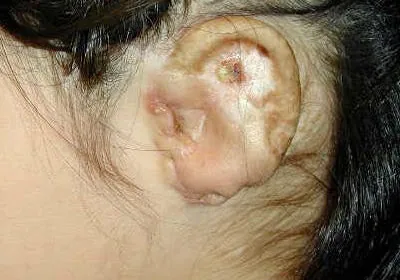 A close-up of a child's ear shows a porous synthetic Medpor implant that has fractured and broken through the overlying skin, exposing the synthetic framework. Implant exposure and fracture are serious complications that can occur with Medpor microtia surgery.