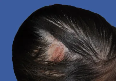 A close-up of a reconstructed ear shows patchy discoloration and visible implant exposure where full-thickness skin grafts failed to blend with the surrounding skin after porous synthetic ear implant surgery. Skin graft color mismatch and implant exposure are recognized complications of Medpor microtia reconstruction.