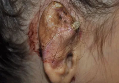 A close-up of the top of a child's head shows a patch of hair loss and irritated skin where the temporoparietal fascia was dissected during porous synthetic ear implant surgery. This type of scalp hair loss is a known complication of Medpor microtia surgery requiring fascia flap harvest.